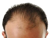 Hair-Loss-Restoration-content.image-